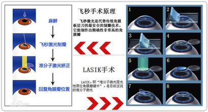 激光在治療近視方面的應(yīng)用